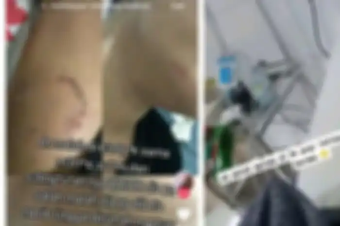 Pergoki suami selingkuh, wanita malah digigit pelakor hingga infeksi   
