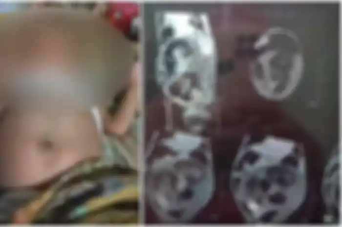 Bayi laki-laki di Sumatera Barat yang perutnya buncit dan diduga hamil. Dokter sebut itu tumor 