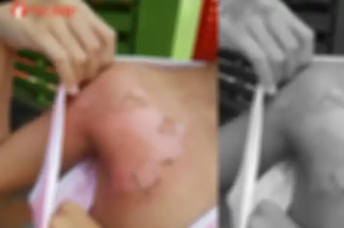 kulitnya melepuh saat mandi