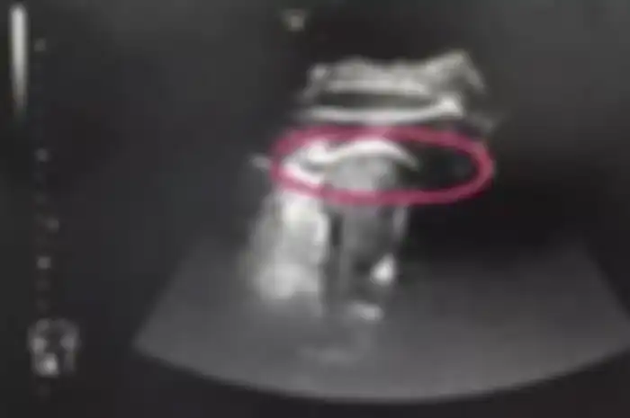 Hasil scan ibu yang mengeluh sakit perut