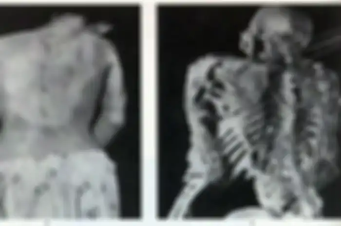 Stone Man Syndrome