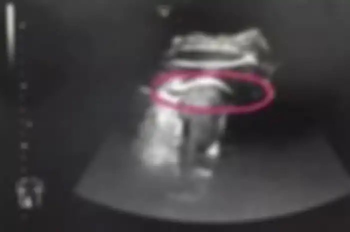 Sakit perut saat hamil membuat janin dalam kandungannya mengalami ini