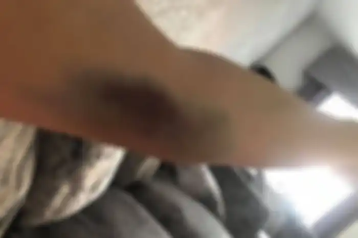 Memar di tubuh Sarah