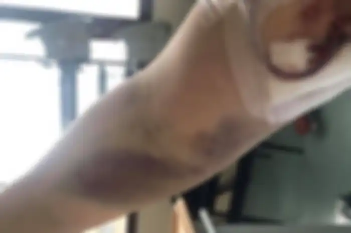 Memar di tubuh Sarah