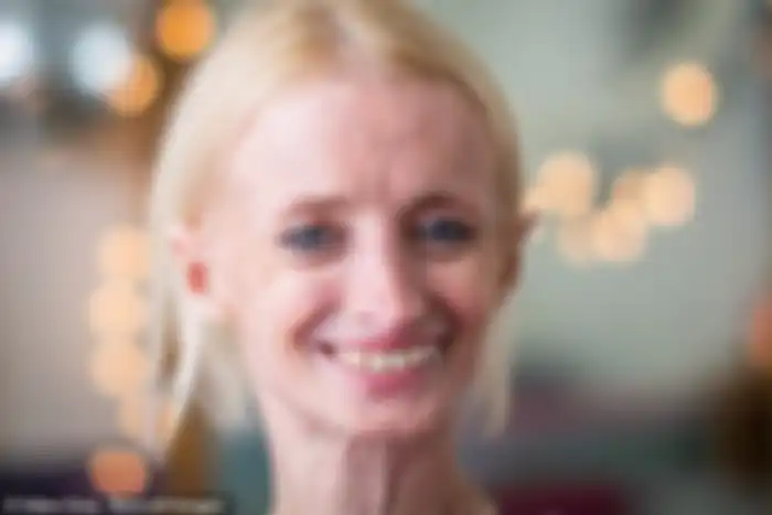 Tiffany Wedekind penderita progeria tertua
