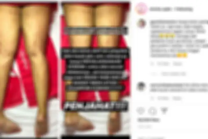 Bahaya pemakaian losion yang mengandung steroid.