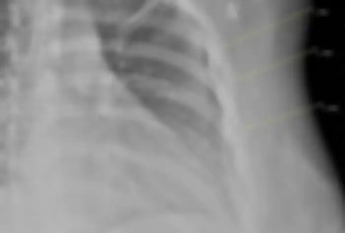Hasil scan sinar X yang menunjukkan tulang kropos.