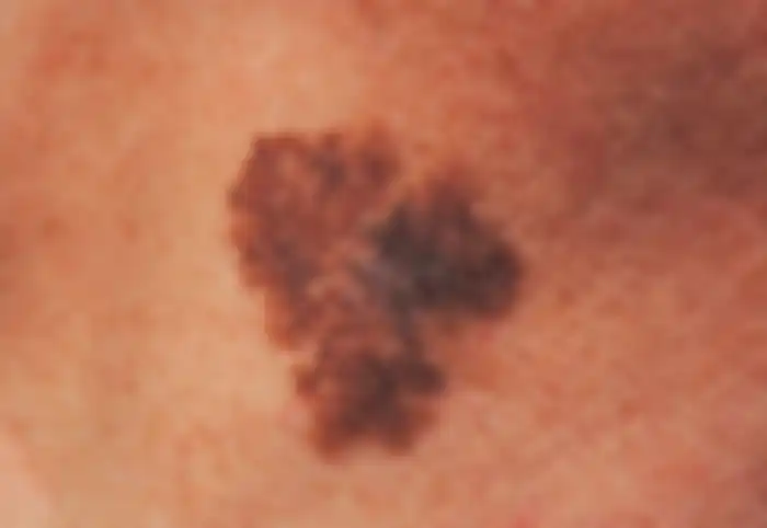 Melanoma Lentigo Maligna