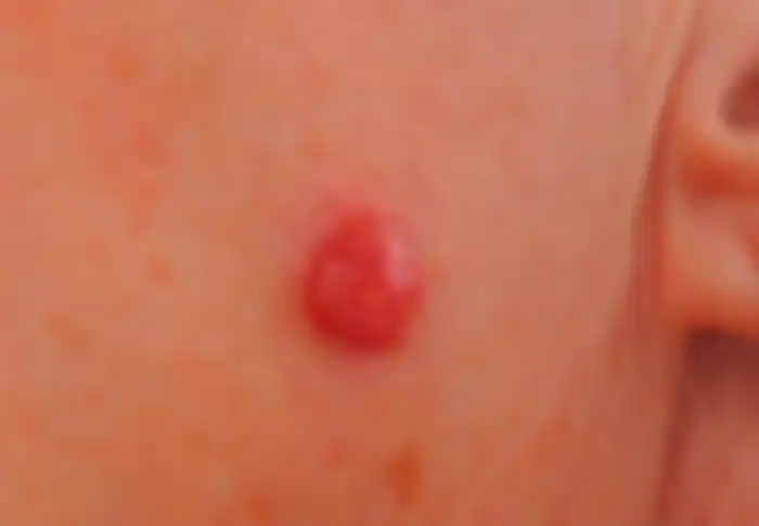 melanoma nodular