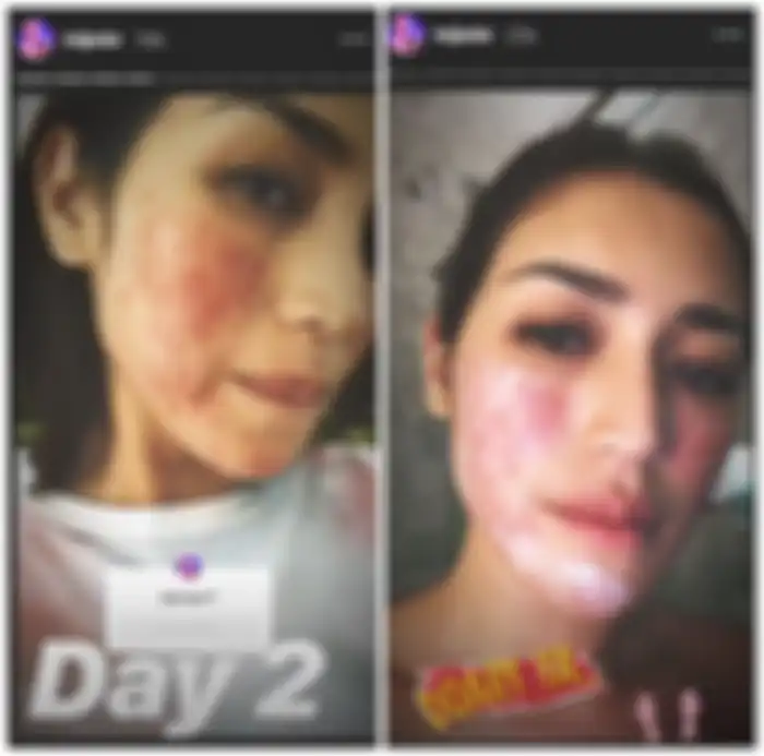 Wajah alergi Jessica Iskandar.