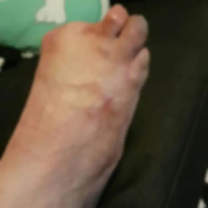 Kondisi kaki Victoria Curthoys.