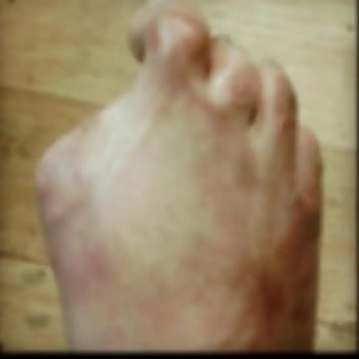 Kondisi kaki Victoria Curthoys.