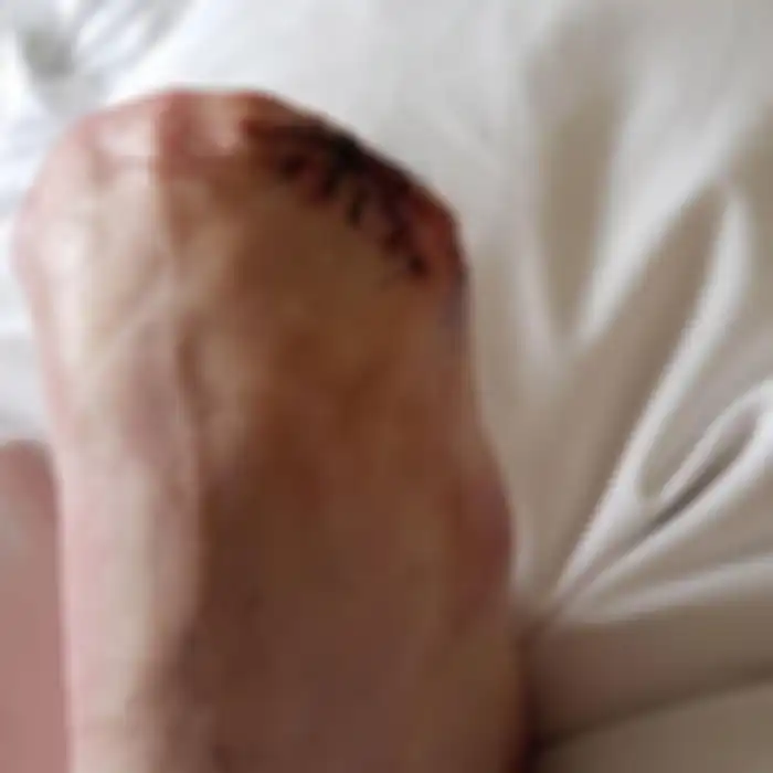 Kondisi kaki Victoria Curthoys.