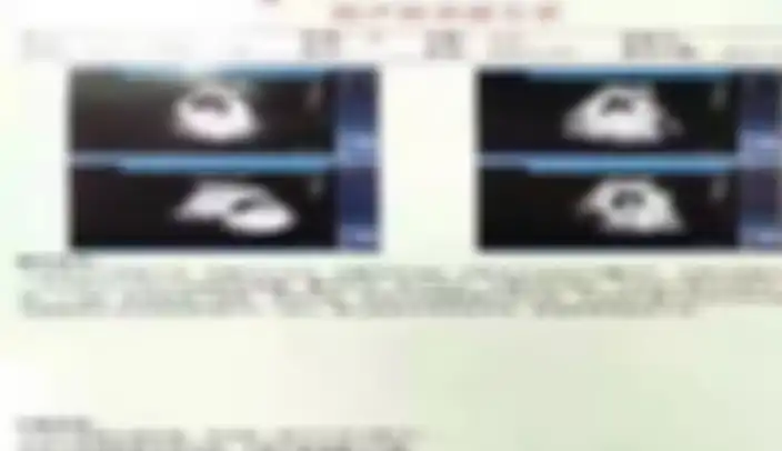 Ternyata memang benar wanita ini menderita kehamilan ektopik.