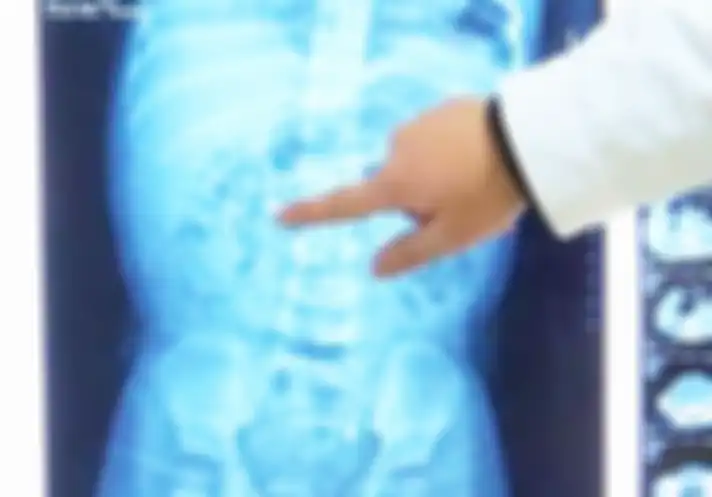 Ada 9 batu ginjal dalam tubuh bayi perempuan ini, dengan ukuran paling besar 2 cm