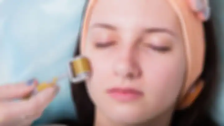 Microneedling