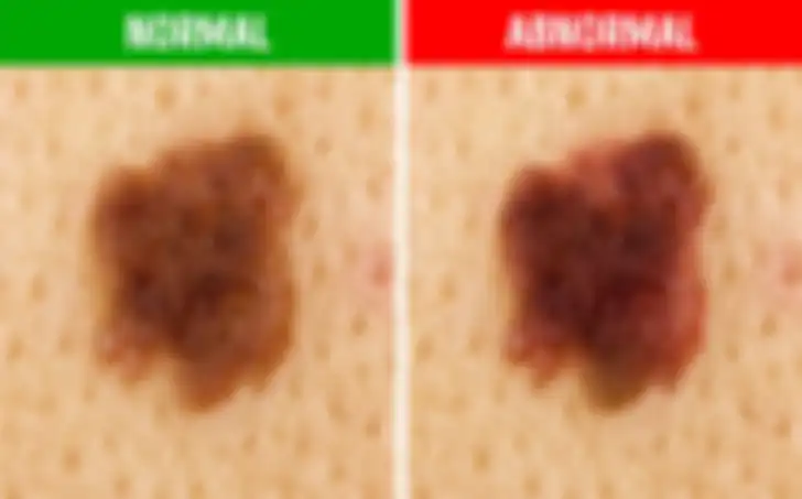 Warna Tahi Lalat