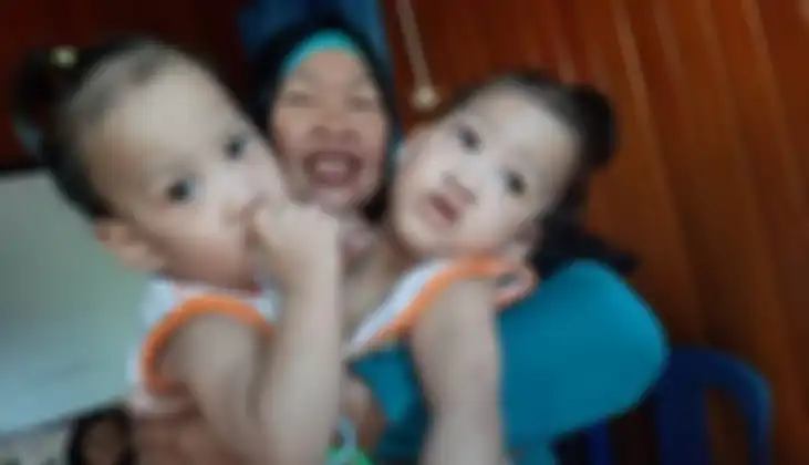 Kondisi bayi Akila dan Azila sebelum operasi pemisahan