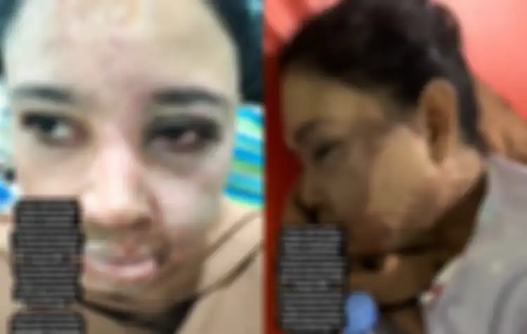 Pilu driver ojol wanita ini disiram air keras oleh suaminya