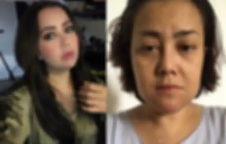 Rency Milano Diduga Jadi Korban Malpraktik Klinik Kecantikan