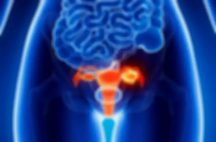 Gejala dan penyebab kista endometriosis