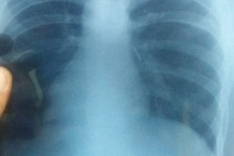Hasil foto rontgen menunjukkan paku bersarang di tubuh Deni, siswa SMP 2 Parigi, Kabupaten Pangandaran yang tak sengaja menelan paku.