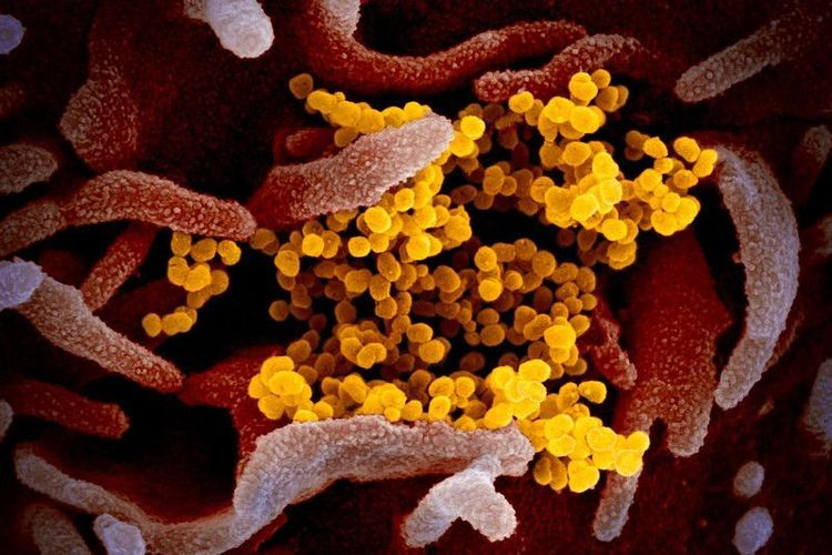 Gambar mikroskop elektron pemindai ini menunjukkan virus corona Wuhan atau Covid-19 (kuning) di antara sel manusia (merah). Sampel virus diambil dari seorang pasien AS yang terinfeksi. Para ahli menambahkan gambar agar lebih tampak