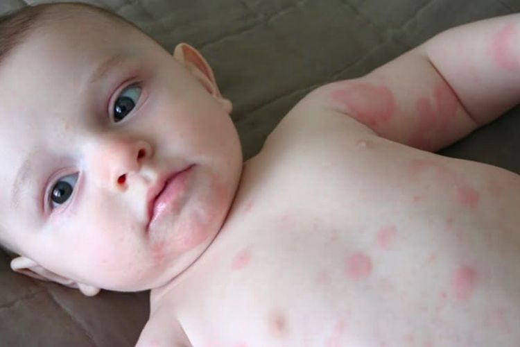 Biduran pada Bayi, Penyebab hingga Cara Mengobati, Jangan Biarkan Si Kecil Menggaruk!