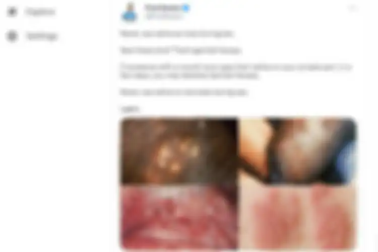Cuitan Twitter tentang air liur sebabkan herpes genital.