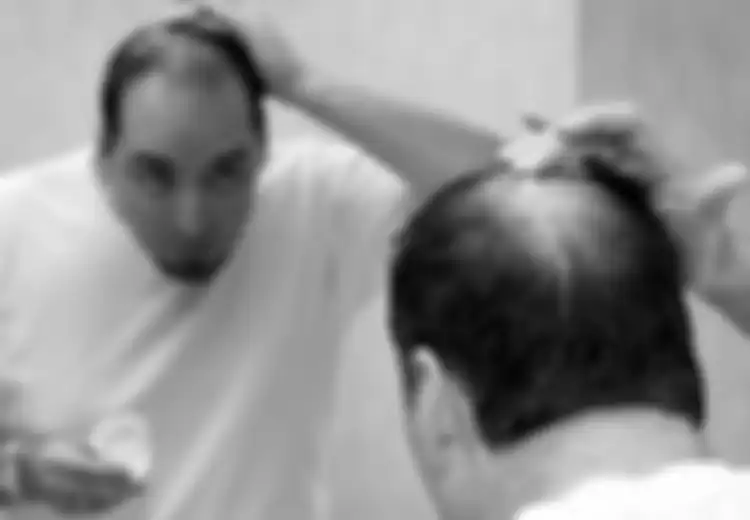 Ketika Rambut Pria Menipis Gara-gara Kebotakan (3)