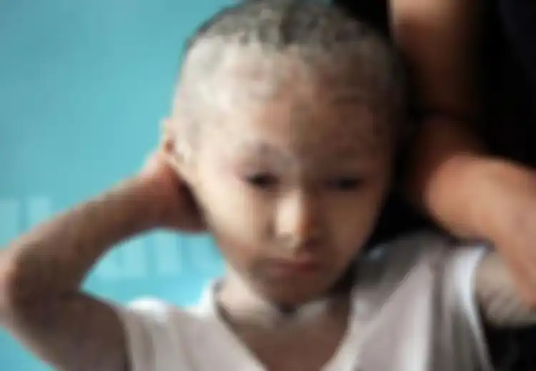 Waspadalah, 1 dari 300 Orang Bisa Menderita Ichthyosis alias Penyakit Kulit Sisik Ikan