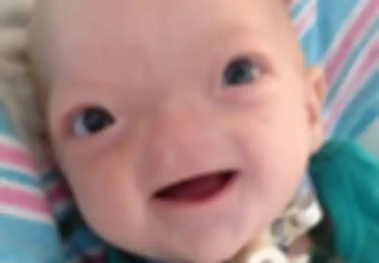 Kisah Bayi Finch, Walau Lahir Tanpa Hidung Tapi Ia Selalu Tersenyum