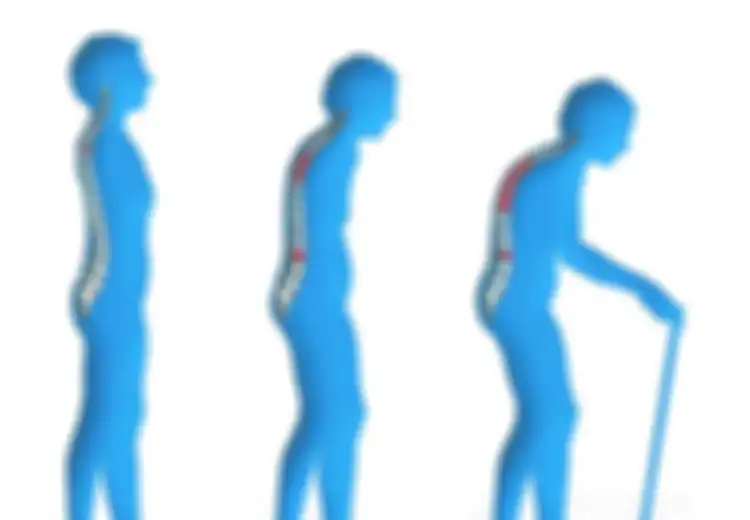 Sebelum Terjadi di Masa Tua, Ikuti 5 Langkah Mudah Mencegah Penyakit Osteoporosis, Salah Satunya Rutin Lakukan Latihan Fisik