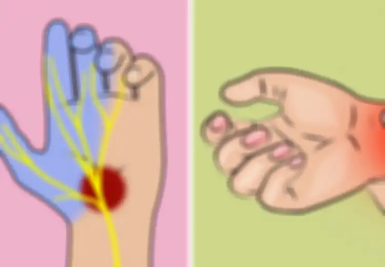 Jangan Disepelekan, Tangan atau Kaki yang Sering Kesemutan Ternyata Bisa Jadi Tanda Penyakit Serius