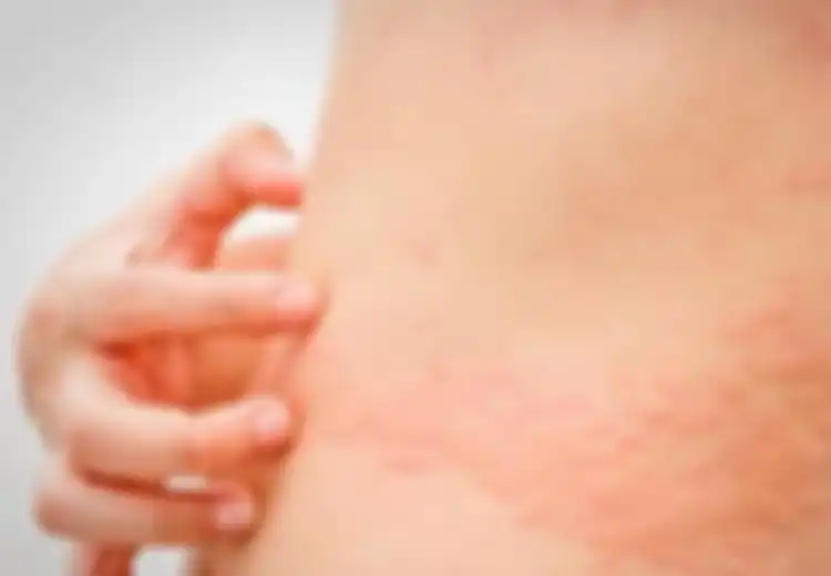 Alami Biduran? Ini Cara Atasi Biduran Tanpa Obat, Sangat Mudah!