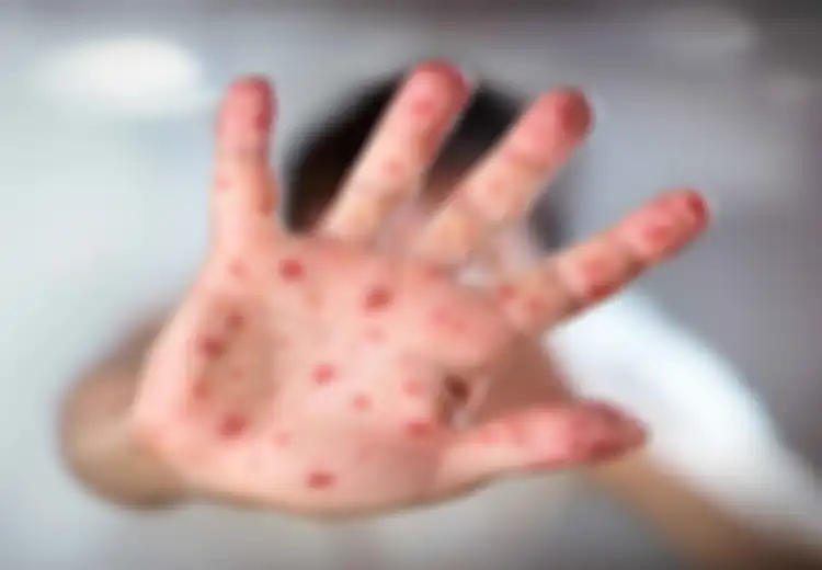 Waspadai Demam Tinggi  dan Sakit Kepala Berat! Inilah Gejala Cacar Monyet dari Hari ke Hari Menurut Kemenkes, Meski Bisa Sembuh Sendiri dan Belum Mewabah di Indonesia