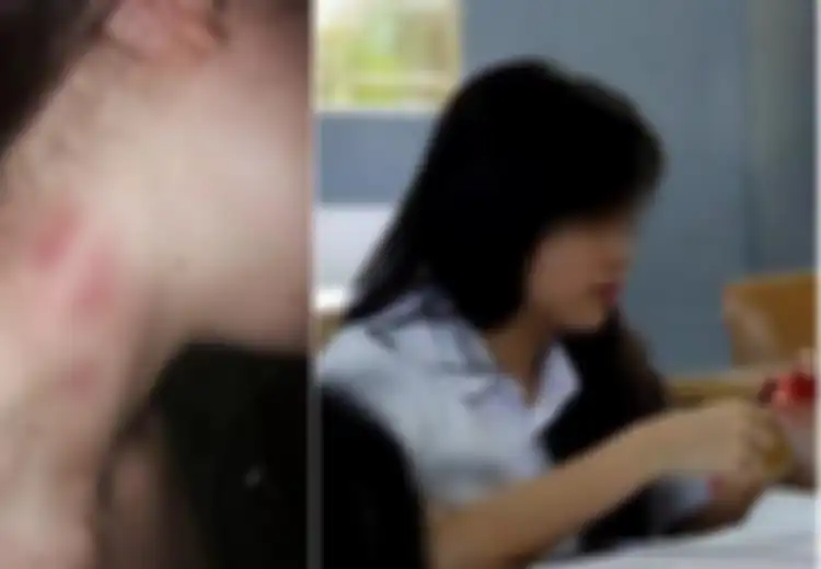 Curiga Lihat 'Cupang' di Leher Putrinya, Setelah Diinterogasi Sang Putri Akhirnya Mengaku Telah Melakukan Hal Ini dengan 5 Pria