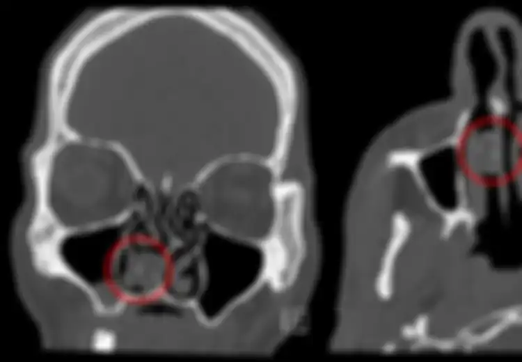 Sering Pusing Mendadak, Dokter Terkejut Ada Ganja Tersangkut di Dalam Hidung Pria Ini Selama 18 Tahun, Kok Bisa?