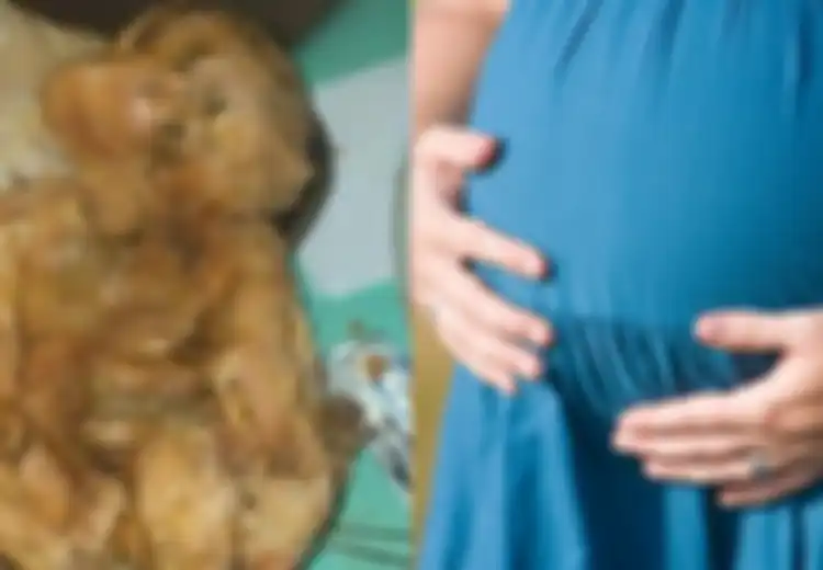 Mengeluh Sakit Perut, Wanita Ini Ternyata Hamil Selama 15 Tahun, Setelah Dilahirkan Kondisi Bayinya Mengenaskan