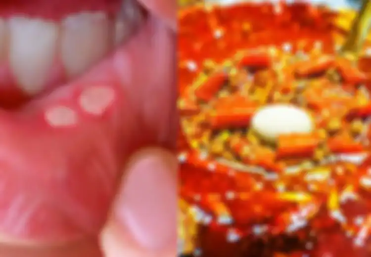 Jika Anda Rentan Alami Sariawan, Hindari 8 Makanan Berikut Ini, Salah Satunya Makanan Pedas
