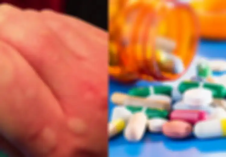 Obat Biduran dengan Antihistamin untuk Alergi dan Efek Sampingnya