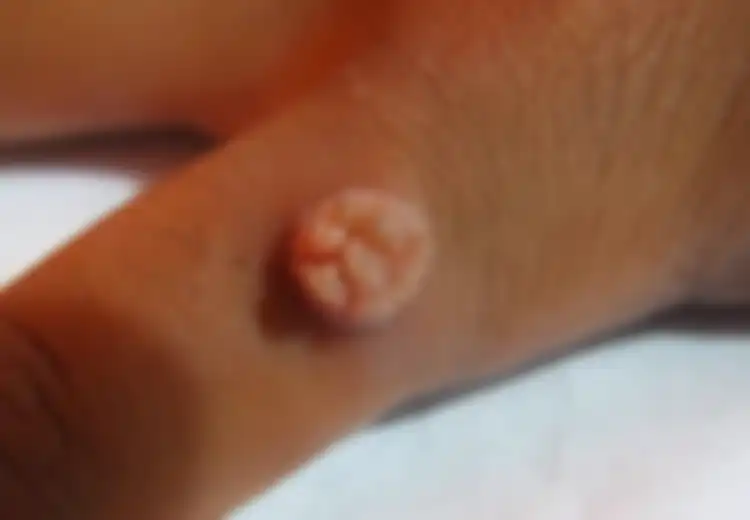 Mudah, Ini 4 Cara Menghilangkan Kutil di Tangan dengan Bahan Alami