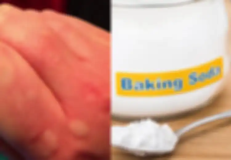 Sebelum Pergi ke Apotek Membeli Antihistamin, Coba Atasi Biduran dengan Baking Soda untuk Hilangkan Gatal-gatal, Begini Caranya!