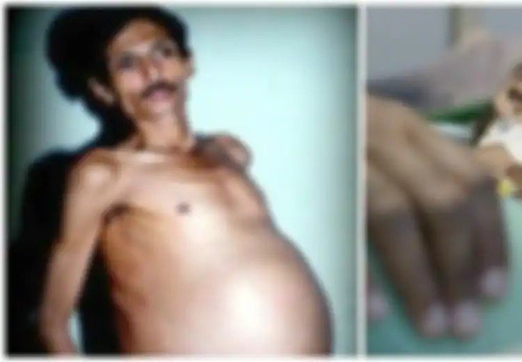 Sungguh Tidak Nalar,Pria Tulen Ini Hamil dan Melahirkan Manusia, Dokter Mengira Perutnya Membesar Karena Tumor Setelah Dibedah Dokter Keheranan Melihat Isinya