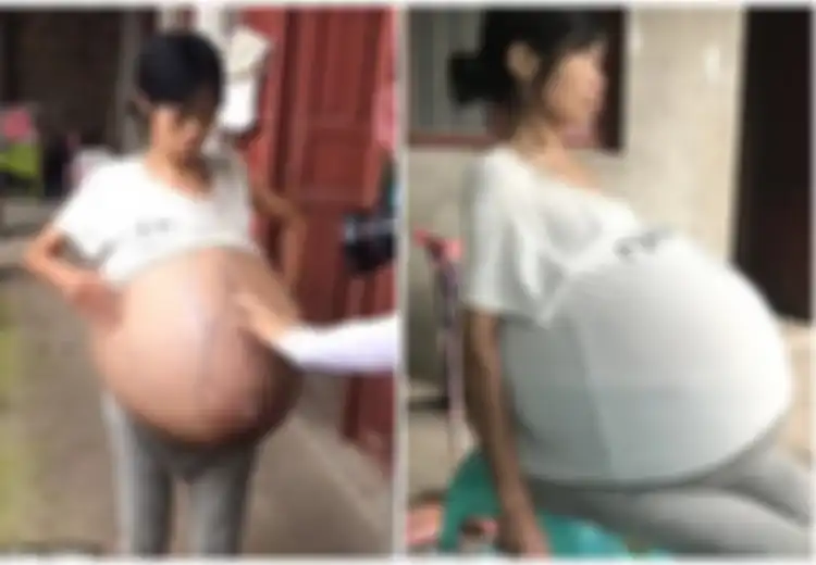 Bukan Hamil, Perut Wanita Ini Terus Membesar Selama 2 Tahun Tanpa Diketahui Penyebabnya, Dibedahpun Dokter Tidak Bisa Menemukan Apapun di Dalamnya