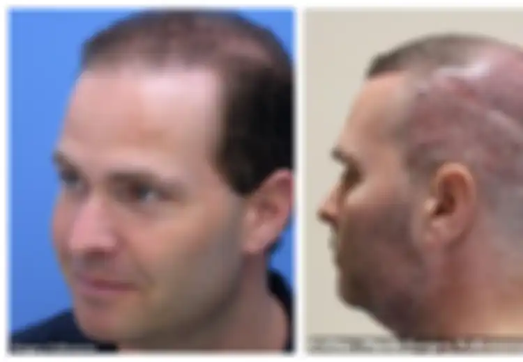Pernikahan Pria Ini Hancur karena Terobsesi dengan Transplantasi Rambut, Lakukan 7 Kali Operasi dan Miliki Banyak Hutang, Ini Awal Mula Ketakutannya