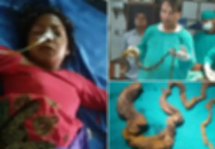 Ada Gumpalan Rambut Seberat 7 Kg di Dalam Perut Remaja 17 Tahun Ini, Ternyata Dia Idap Kondisi Langka yang Membuatnya Makan Rambutnya Sendiri