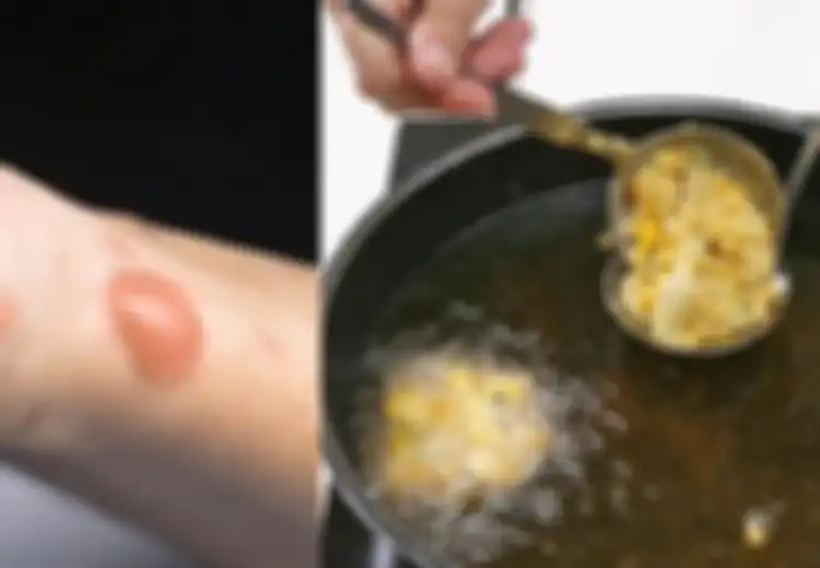 Jangan Dibiarkan Terlalu Lama, Begini Cara Obati Luka Kulit Akibat Percikan Minyak Panas dengan Bahan Dapur!