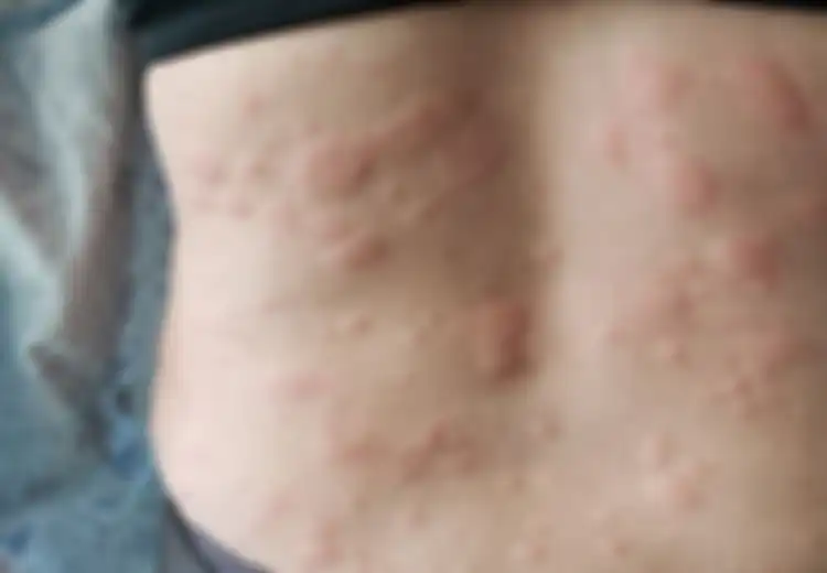 Tiga Bahan Alamiah Ini Bisa Jadi Obat Alami Biduran, Apa Saja?