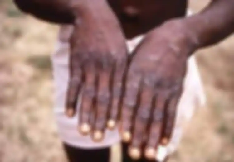 Sebut Cacar Monyet Tidak Mungkin Menjadi Pandemi, Menkes Singapura Imbau Cara Mencegah Monkeypox